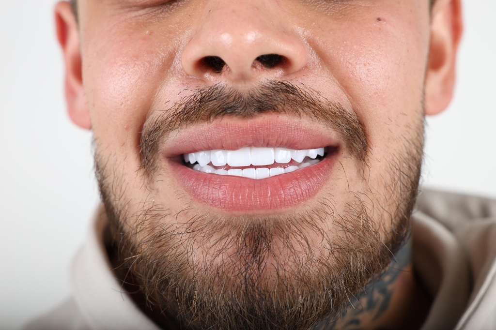 After Zirconia Crown Treatment